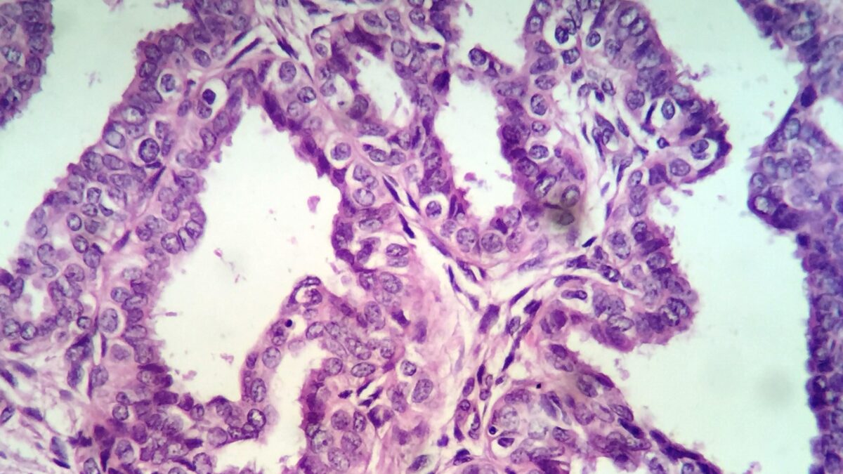 Papiloma intraductal de mama, el rol de la PAAF como herramienta diagnóstica