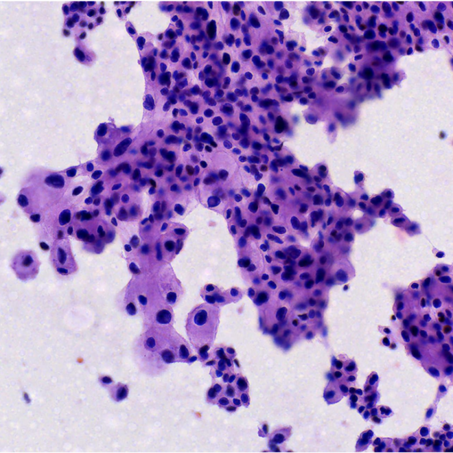 Carcinoma cromófobo renal