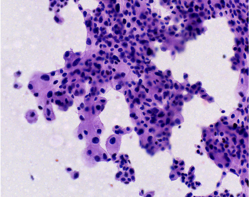 Carcinoma cromófobo renal