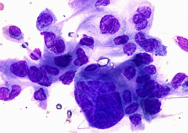 t tzanck - fig 1