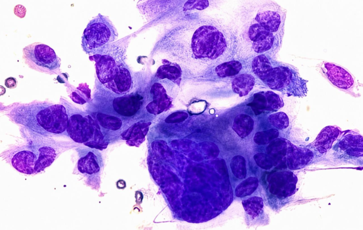 t tzanck - fig 1
